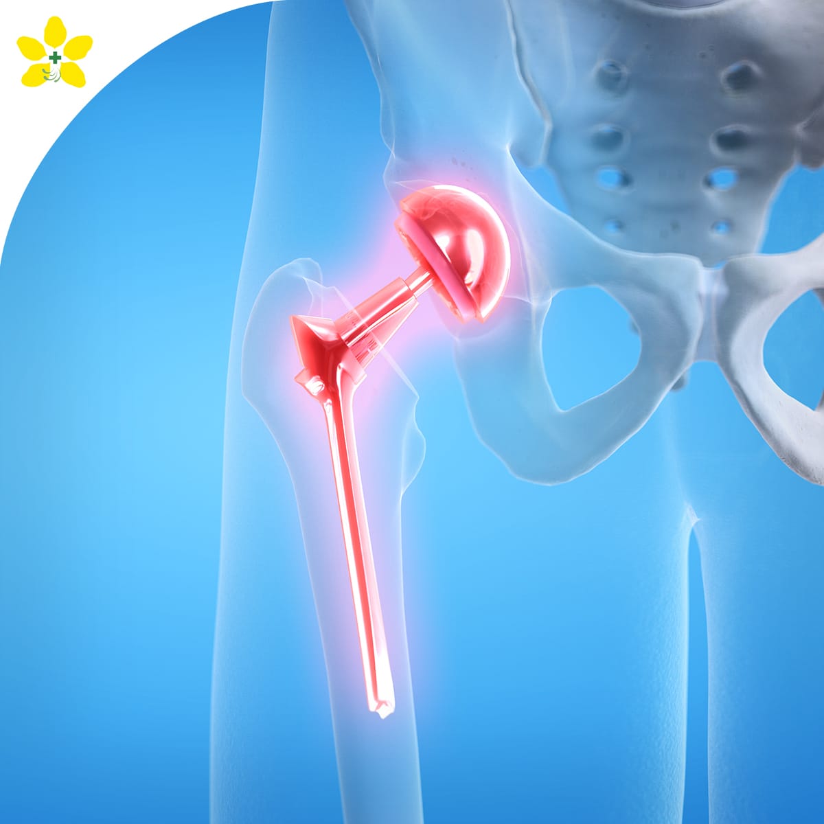 Hips Package Hip Replacement Package - 拉查普魯克醫院