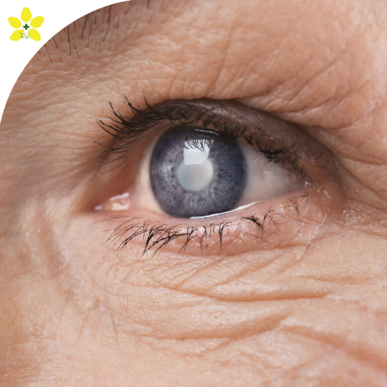 Cataract Extraction Package Ratchaphruek Hospital